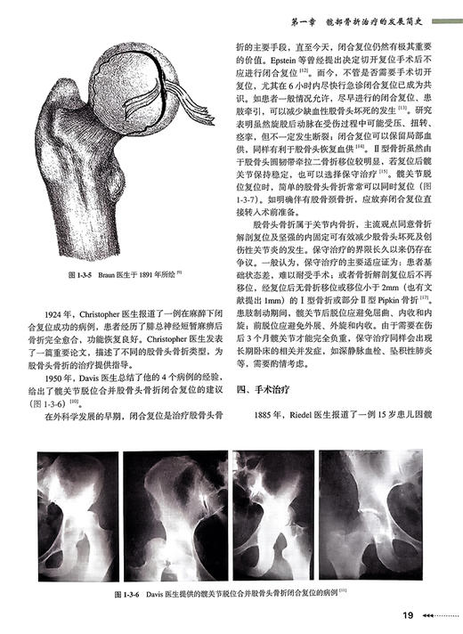 现代髋部骨折治疗理念与技术 周方主编 基础研究骨折分类临床治疗 围手术期处理快速康复创伤骨科北京大学医学出版社9787565927423 商品图4