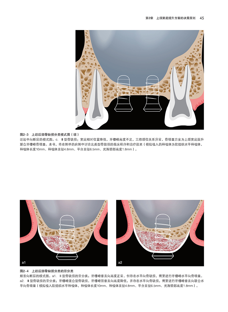 上颌窦底提升-精彩页6.jpg