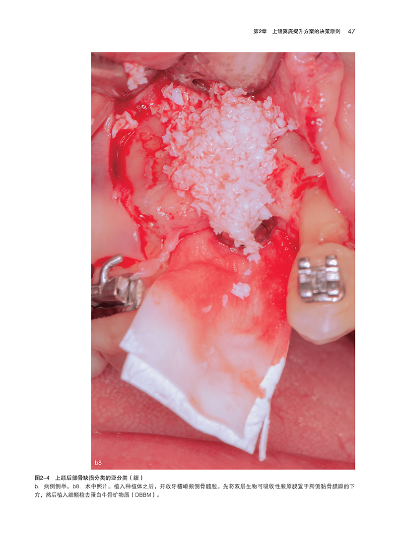 上颌窦底提升-精彩页8.jpg