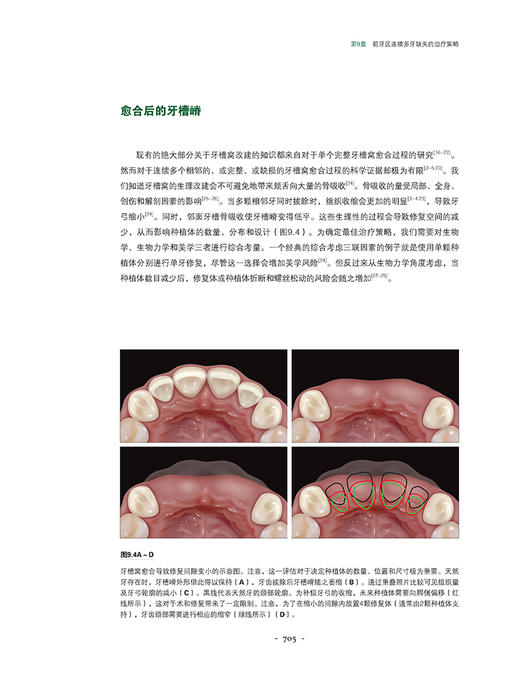 美学区牙周种植手术精要 张海东 刘琦主译 牙龈退缩治疗计划手术操作 露龈笑治疗方法 口腔种植 辽宁科学技术出版社9787559127921 商品图4