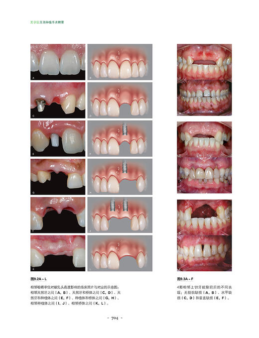 美学区牙周种植手术精要 张海东 刘琦主译 牙龈退缩治疗计划手术操作 露龈笑治疗方法 口腔种植 辽宁科学技术出版社9787559127921 商品图3