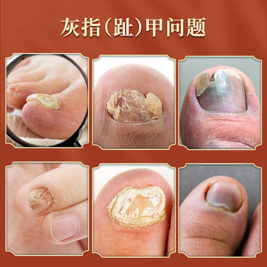 【买2送1】香港大药房甲姿迪灰指甲液体敷料 深层渗透 滋养甲床促养新甲 手足通用液体敷料灰甲液30ml/瓶 商品图1