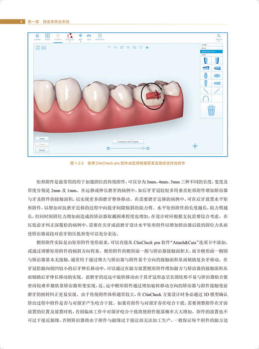 口腔正畸隐适美隐形矫治技术 赖文莉主编 无托槽隐形矫治技术特点临床操作技巧 典型病例诊断治疗 人民卫生出版社9787117341103 商品图3