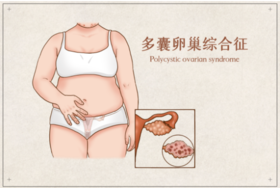  多囊卵巢综合征，自救指南！ 