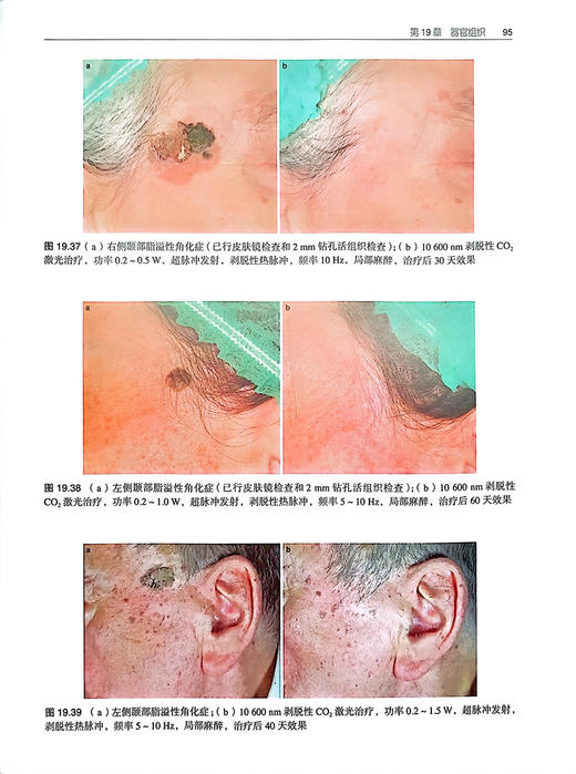 激光与光皮肤病治疗实用图谱 李文志 译 临床医师皮肤激光治疗教科书 皮肤疾病美容激光治疗图谱 北京大学医学出版社9787565927492 商品图4