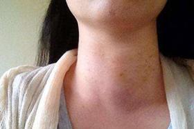 一场甲癌切除手术，让31岁的王女士后悔终生。90%的人会踩的大坑...