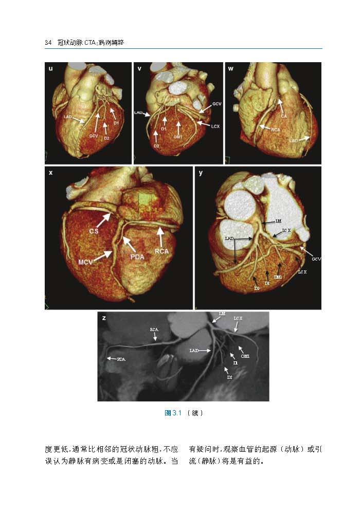 冠状动脉CTA:病例图解第3章_Page_04.jpg