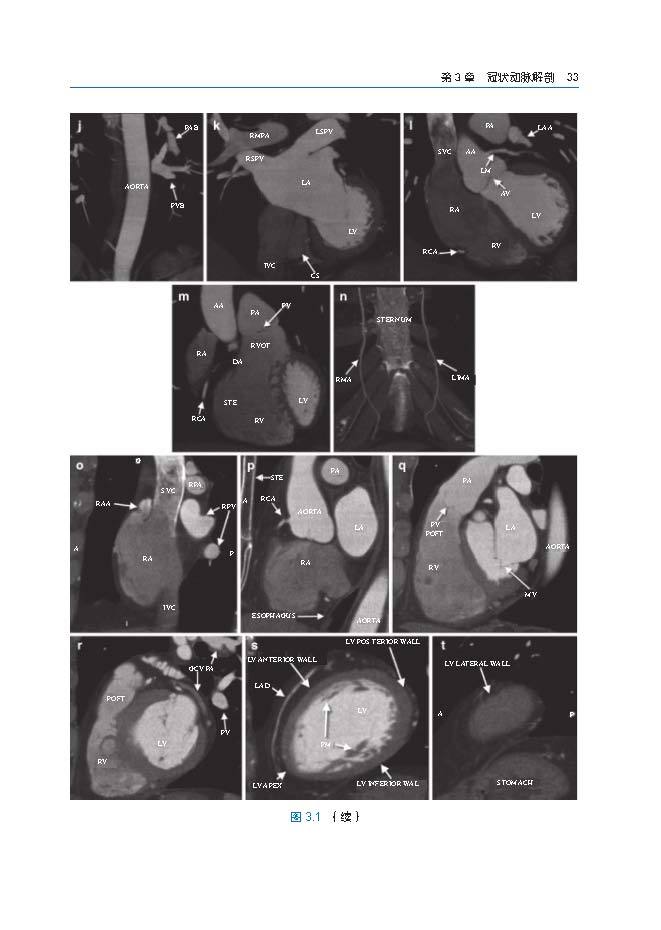 冠状动脉CTA:病例图解第3章_Page_03.jpg