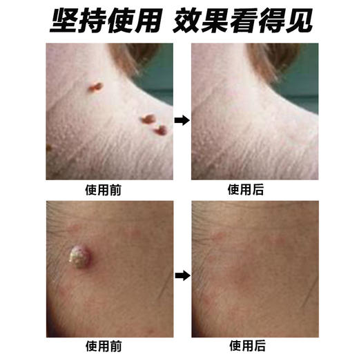 【刺瘊不见】刺瘊膏  深层渗入解决困扰  肉刺瘊子肉粒  直达根源一抹平  30g/盒 商品图2