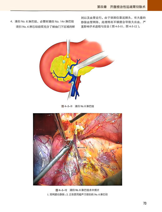 胃癌规范化手术 季加孚 步召德 配视频 胃癌开腹手术操作步骤 实际解剖术中照片 肿瘤外科治疗 北京大学医学出版社9787565927928 商品图4