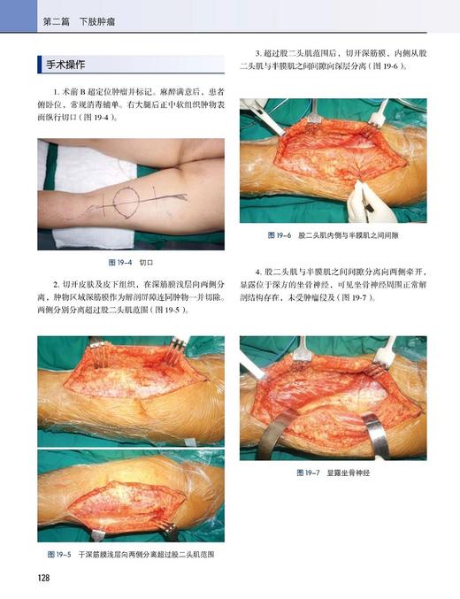 软组织肿瘤规范化手术 朱晓辉 李远主编 配视频 外科解剖 手术入路手术要点注意事项 并发症防治 北京大学医学出版社9787565927911 商品图4