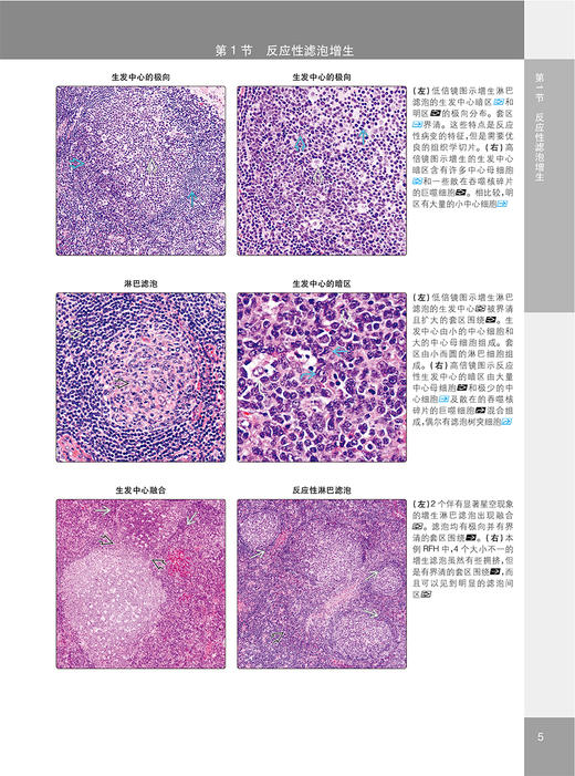 淋巴结及结外淋巴瘤病理诊断学 第2版 高子芬 刘翠苓 译 临床病理特征诊断要点 血液病理医生案头手册9787117343596人民卫生出版社 商品图3