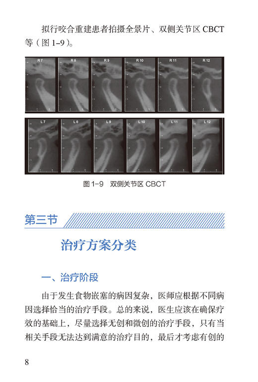 食物嵌塞的修复治疗 郝亮 编 图解口腔美学种植修复临床规范 牙齿食物嵌塞牙体修复治疗技术要点 中国医药科技出版社9787521437690 商品图3