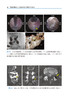 局麻经椎间孔入路全内镜下腰椎手术技术 谢炜星 译 TF-FESS技术解剖椎间盘切除术减压术 脊柱外科9787565926846北京大学医学出版社 商品缩略图3