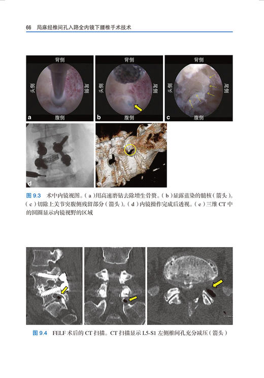 局麻经椎间孔入路全内镜下腰椎手术技术 谢炜星 译 TF-FESS技术解剖椎间盘切除术减压术 脊柱外科9787565926846北京大学医学出版社 商品图3