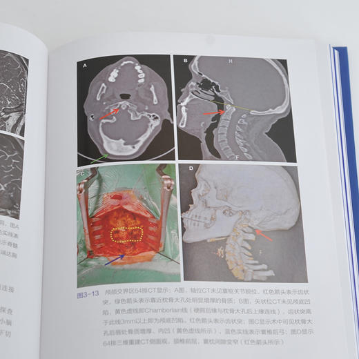 Chiari畸形的精准手术治1疗 商品图5