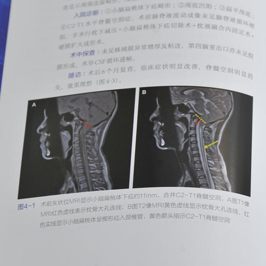 Chiari畸形的精准手术治1疗 商品图8
