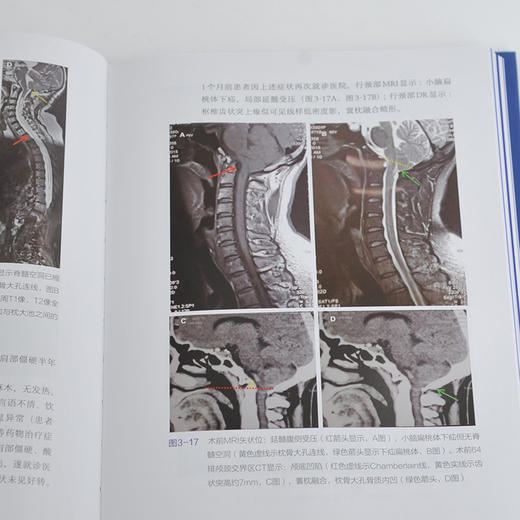 Chiari畸形的精准手术治1疗 商品图7