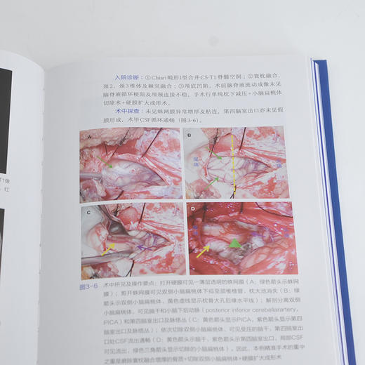 Chiari畸形的精准手术治1疗 商品图4