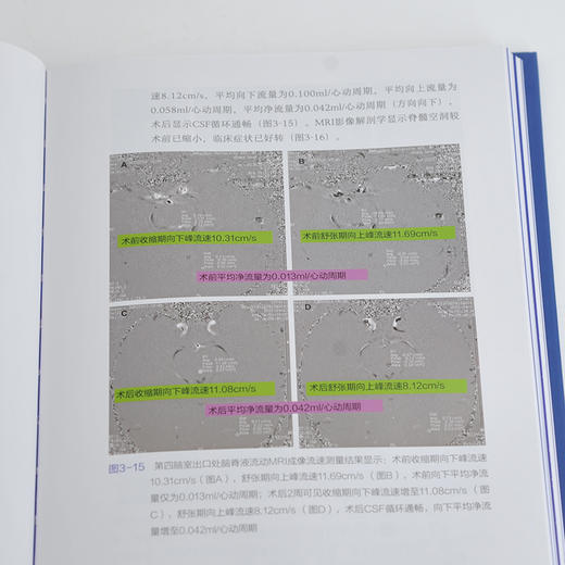 Chiari畸形的精准手术治1疗 商品图6