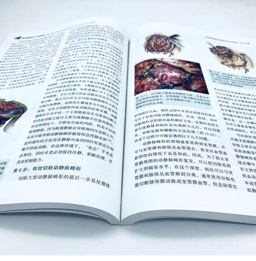 现货 “ 传世 ” 新作丨《脑动静脉畸形与动静脉瘘》中译本正式出版，Aaron 教授等主编，刘爱华、谢万福、顾宇翔教授主译 商品图2