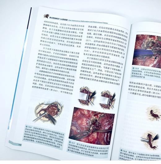 现货 “ 传世 ” 新作丨《脑动静脉畸形与动静脉瘘》中译本正式出版，Aaron 教授等主编，刘爱华、谢万福、顾宇翔教授主译 商品图4