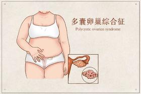 你了解“多囊卵巢综合症”吗？