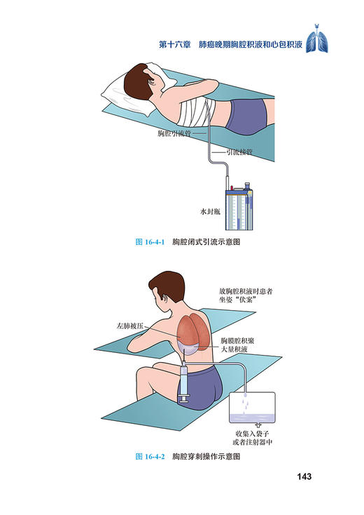 当代肺癌面面观 张玉蛟 等编 肺癌医学科普知识 预防诊治技术 并发症处理 医保流程 海外就诊途径9787565928079北京大学医学出版社 商品图4