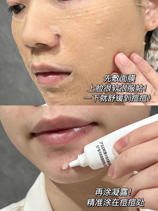 敷尔佳定海神针祛痘凝胶  控油淡化祛痘印痘坑修复粉刺闭口10g 商品图2