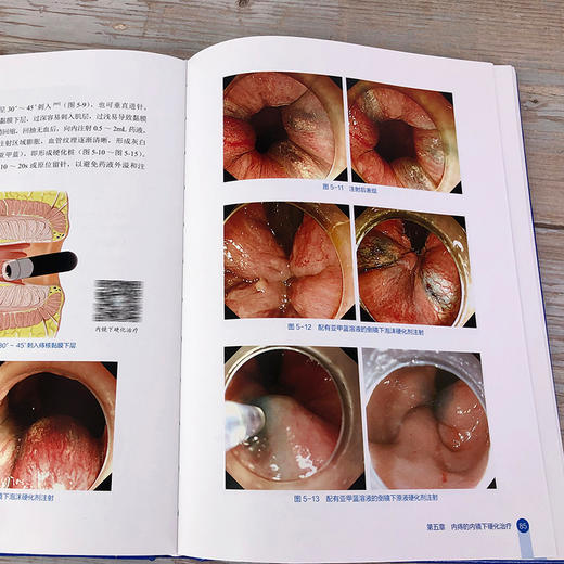 实用内镜下痔病诊断与治1疗 商品图8