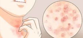  手指起泡、湿疹反复？可能是这个脏器虚了，别只知道“祛湿” 