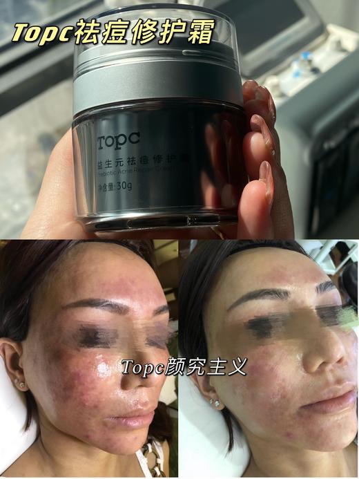 TOPC修护祛痘膏50g☀真正无酸，从根本改善我们的皮肤问题 祛痘膏 商品图2
