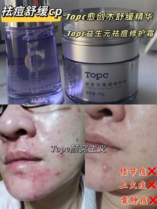 TOPC修护祛痘膏50g☀真正无酸，从根本改善我们的皮肤问题 祛痘膏 商品图1