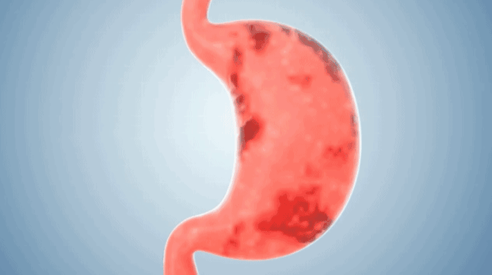 美国FDA认证！麻省总医院指定！精准抗幽！呵护肠胃，远离便秘口臭不消化！