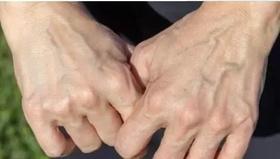  “青筋” 凸起，意味着什么?你知道吗？ 