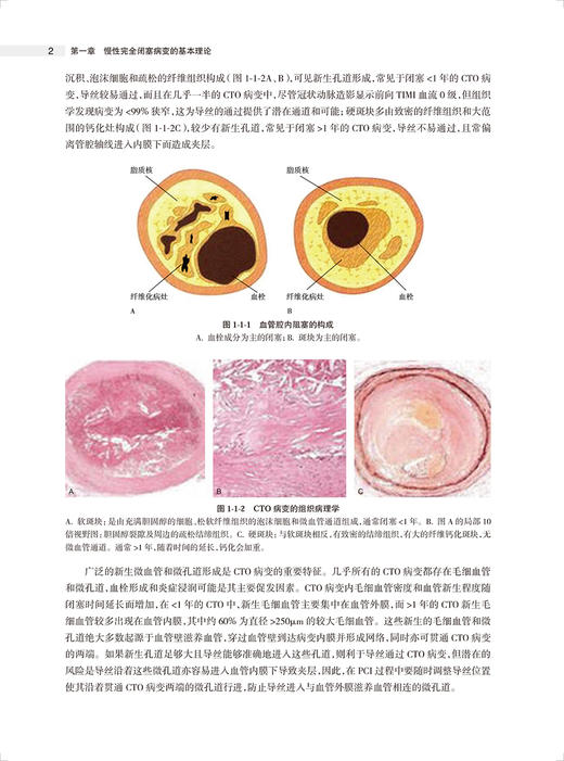 攻克CTO 慢性完全闭塞冠状动脉病变介入治疗 第2版 荆全民等编 OCT病变生理学 介入治疗征正向开通技术等操作细节 人民卫生出版社 商品图3