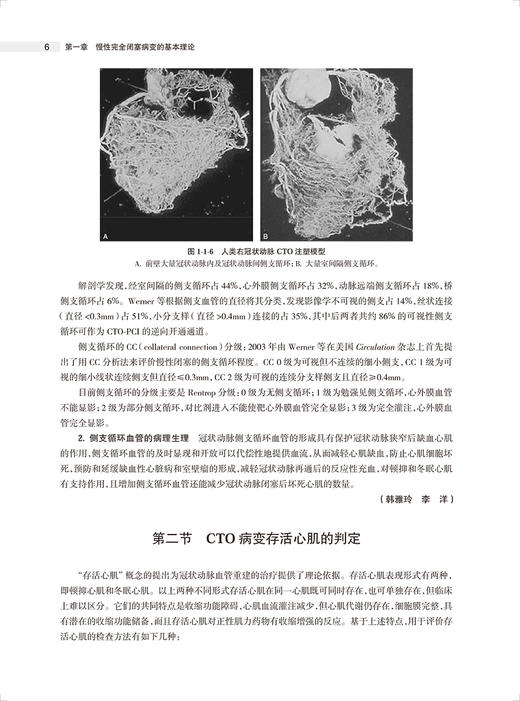 攻克CTO 慢性完全闭塞冠状动脉病变介入治疗 第2版 荆全民等编 OCT病变生理学 介入治疗征正向开通技术等操作细节 人民卫生出版社 商品图4