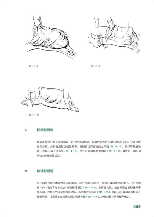 心脏外科手绘手术图谱 精准手绘+操作视频+要点注释 徐国成等编 临床手绘手术图谱丛书 心血管外科中核心手术操作 人民卫生出版社 商品图3