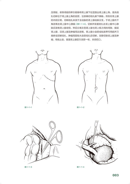 泌尿外科手绘手术图谱 精准手绘+操作视频+要点注释 徐国成等编 临床手绘手术图谱丛书 常规开放手术及各种术式 人民卫生出版社 商品图3