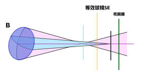 关于散光眼的治疗你知道多少？