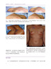 乳房整形 乳房填充调整及重建的综合评估及整形 吕青 谭秋雯主译 整形外科学手术操作 脂肪移植术乳房再造术 辽宁科学技术出版社 商品缩略图3