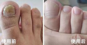 灰指甲易传染、难治愈？这个方法让你新甲换旧甲，恢复白亮不复发