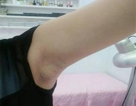  腋窝有包，千万不要以为这是肥胖，这是比肥胖严重得多的淋巴瘀堵!！一定要警惕 