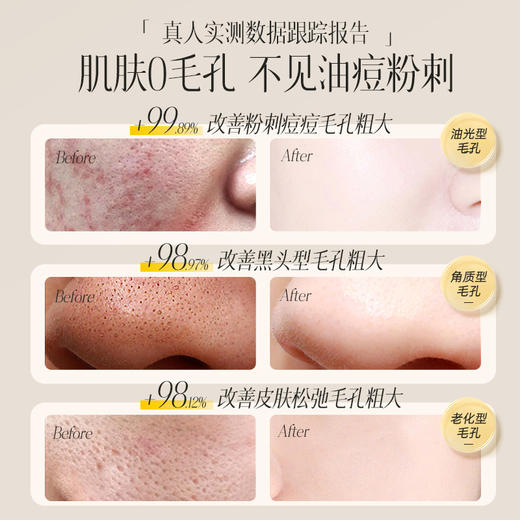 【⚡抢！第2件0元，需拍2件】儒意杏仁酸毛孔精华液收缩毛孔祛痘淡印去黑头闭口粉刺|儒意官方旗舰店 商品图3