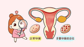多囊卵巢 
