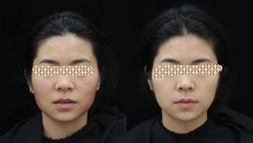  为啥抗衰非得选热玛吉和超声炮？ 