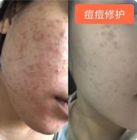 【Alinda私人定制】痘痘修护个案