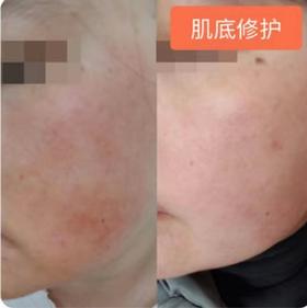 【Alinda私人订制】受损角质修护个案