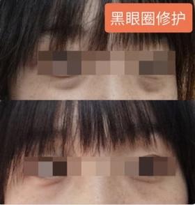 【Alinda私人订制】黑眼圈修护个案
