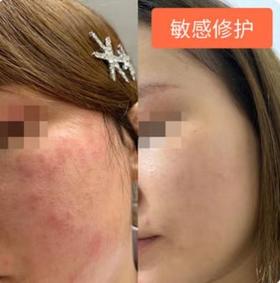 【Alinda私人定制】敏感修护个案